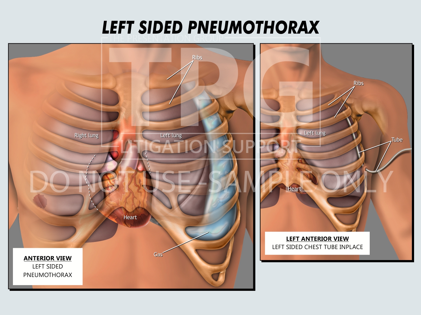 Pneumothorax/Medical Illustration - Presentation Group