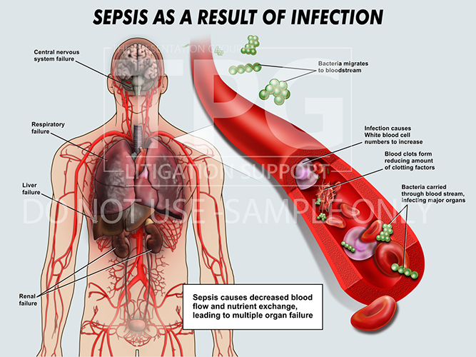Sepsis/Medical Illustration - Presentation Group