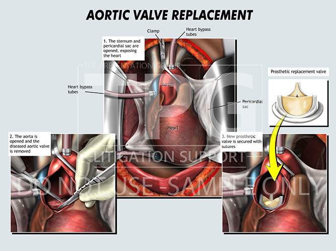 Aortic Valve Replacement/Medical Illustration - Presentation Group