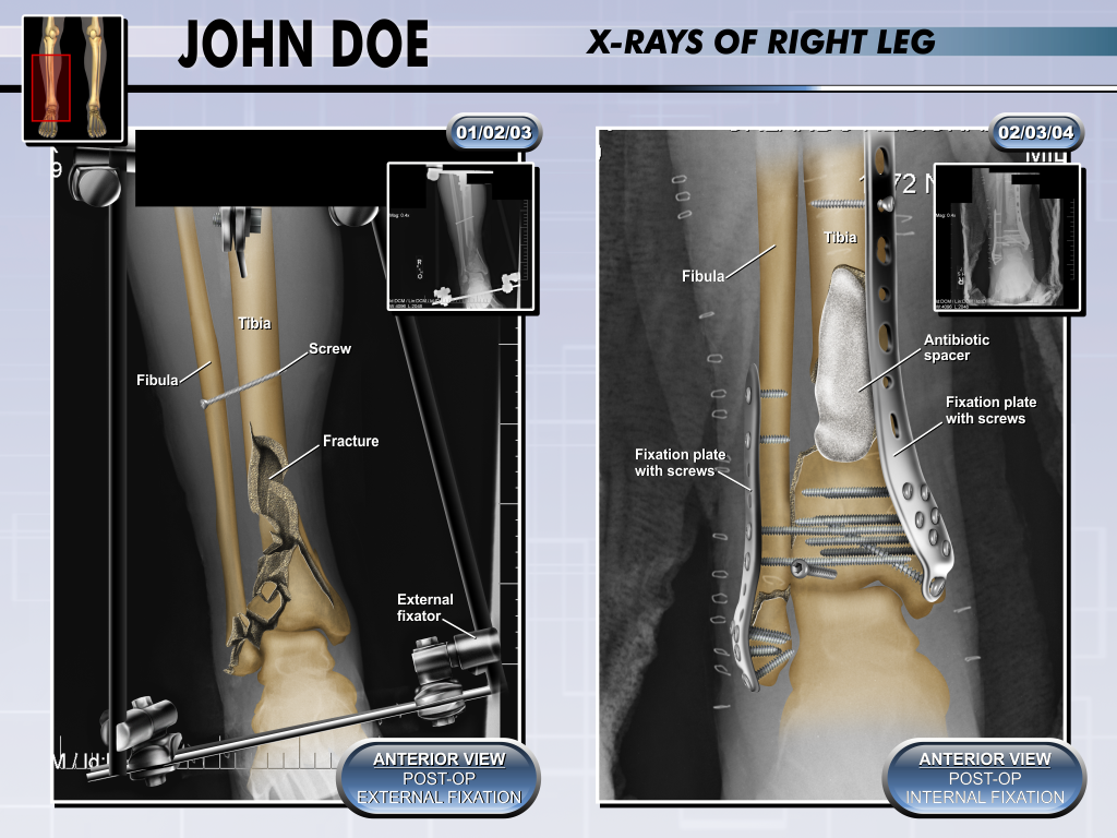 Ankle X-ray - Presentation Group